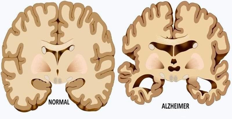 ¿Qué es el Alzheimer?