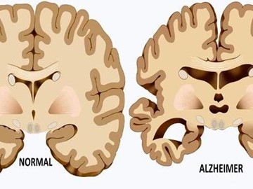 ¿Qué es el Alzheimer?